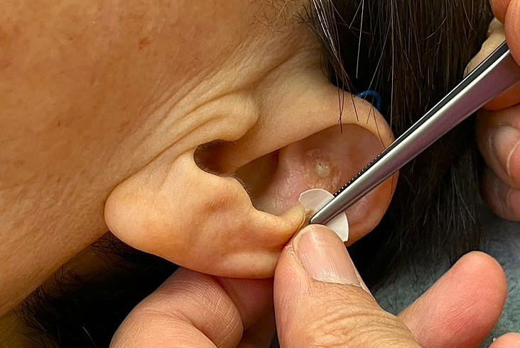 耳介画像と鍼灸で自律神経と血流のバランスを整える施術風景